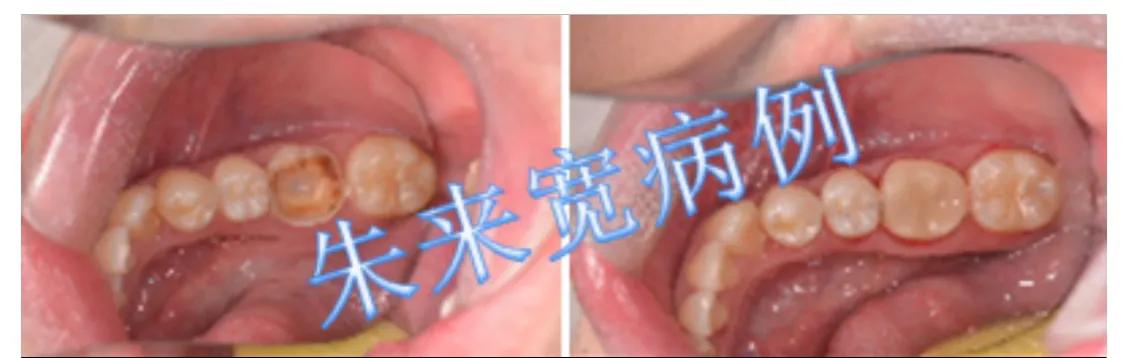 牙齿历险记（第12集）补牙材料