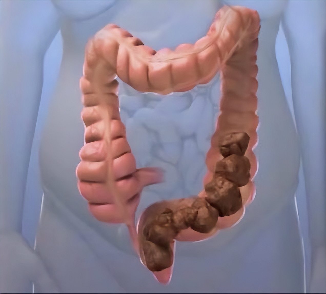 肛肠肿胀疼痛怎么治,肛肠内有紧缩性疼痛