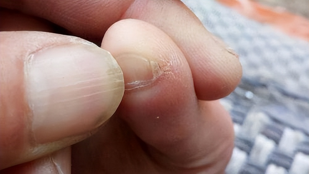 为什么有的人小脚趾指甲是一坨,小脚趾分两半的人究竟什么来历