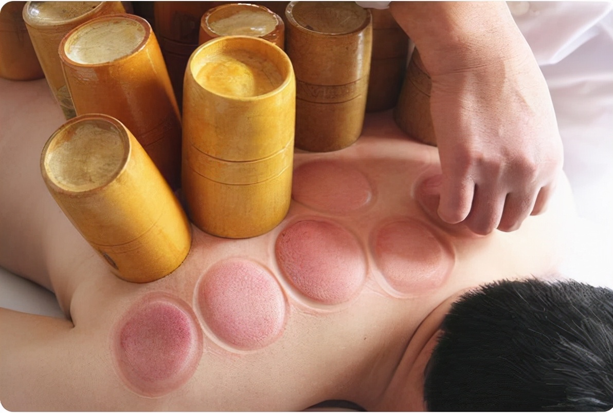 拔火罐时，后背吸出的瘀血，真的是毒素吗？来听听医生的答案