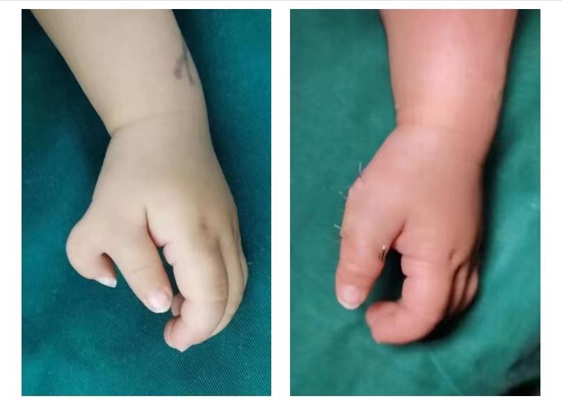 骨科医生手畸形,先天性手关节畸形弯曲