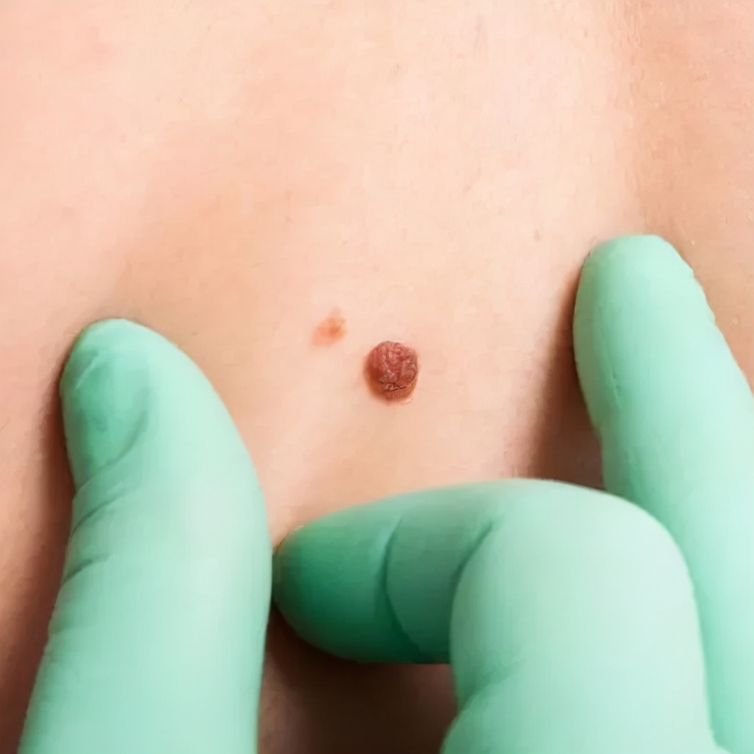 如何区别黑痣和黑色素瘤,怎么分清是黑色素瘤还是黑色的痣