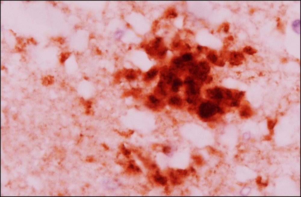 感染无药可救？烹煮杀不死的朊病毒，是上帝刻在基因的“禁令”？