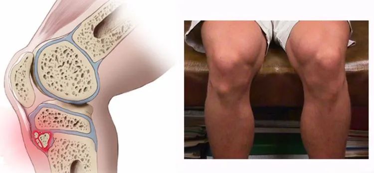 膝盖前面肿了一个包,孩子膝盖上长了一个疙瘩