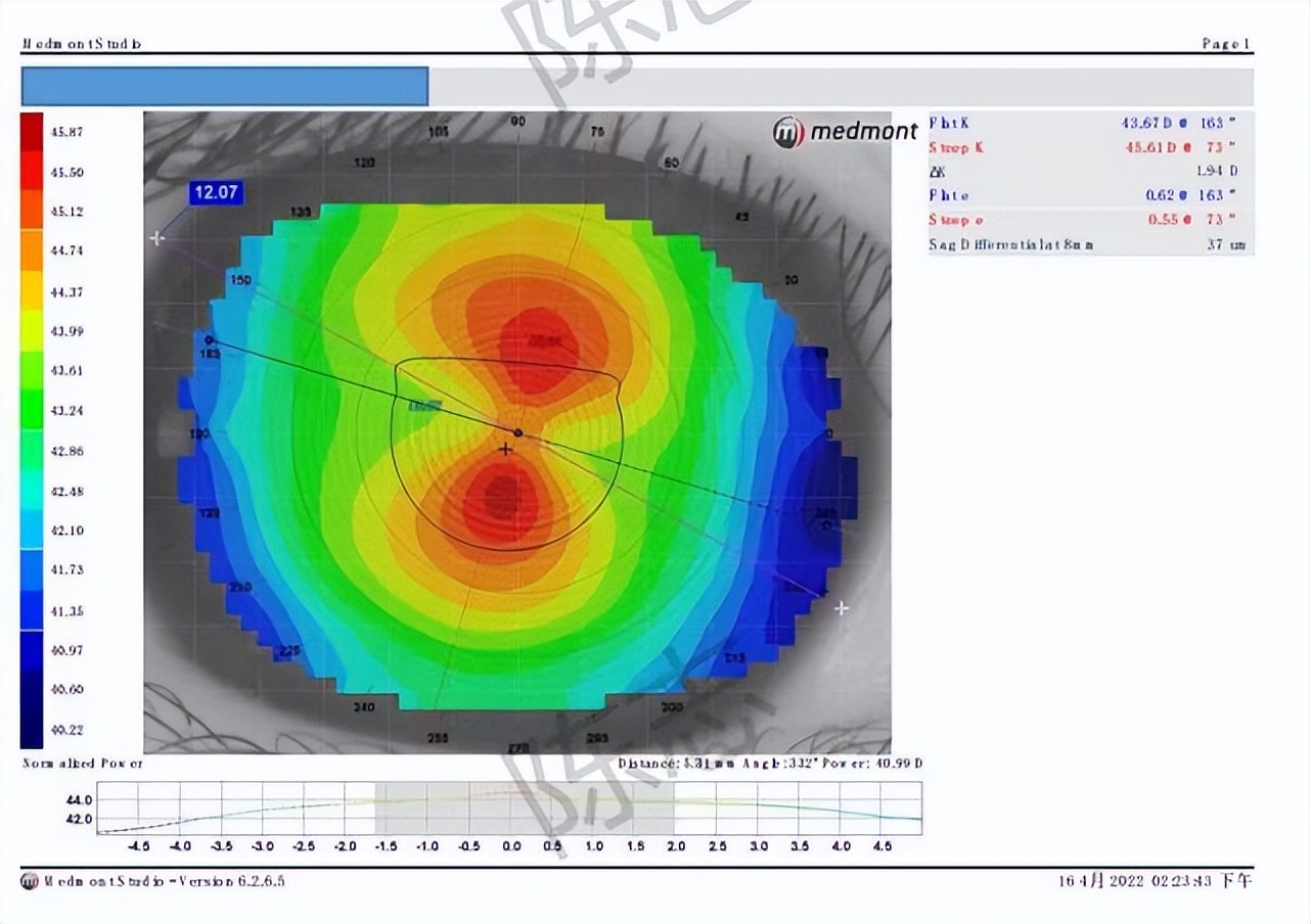 角膜接触镜验配案例图解,戴角膜塑形镜反复出现点染的原因