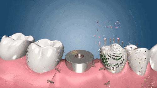 种植牙的流程分多少期,种植牙的过程包含哪些流程