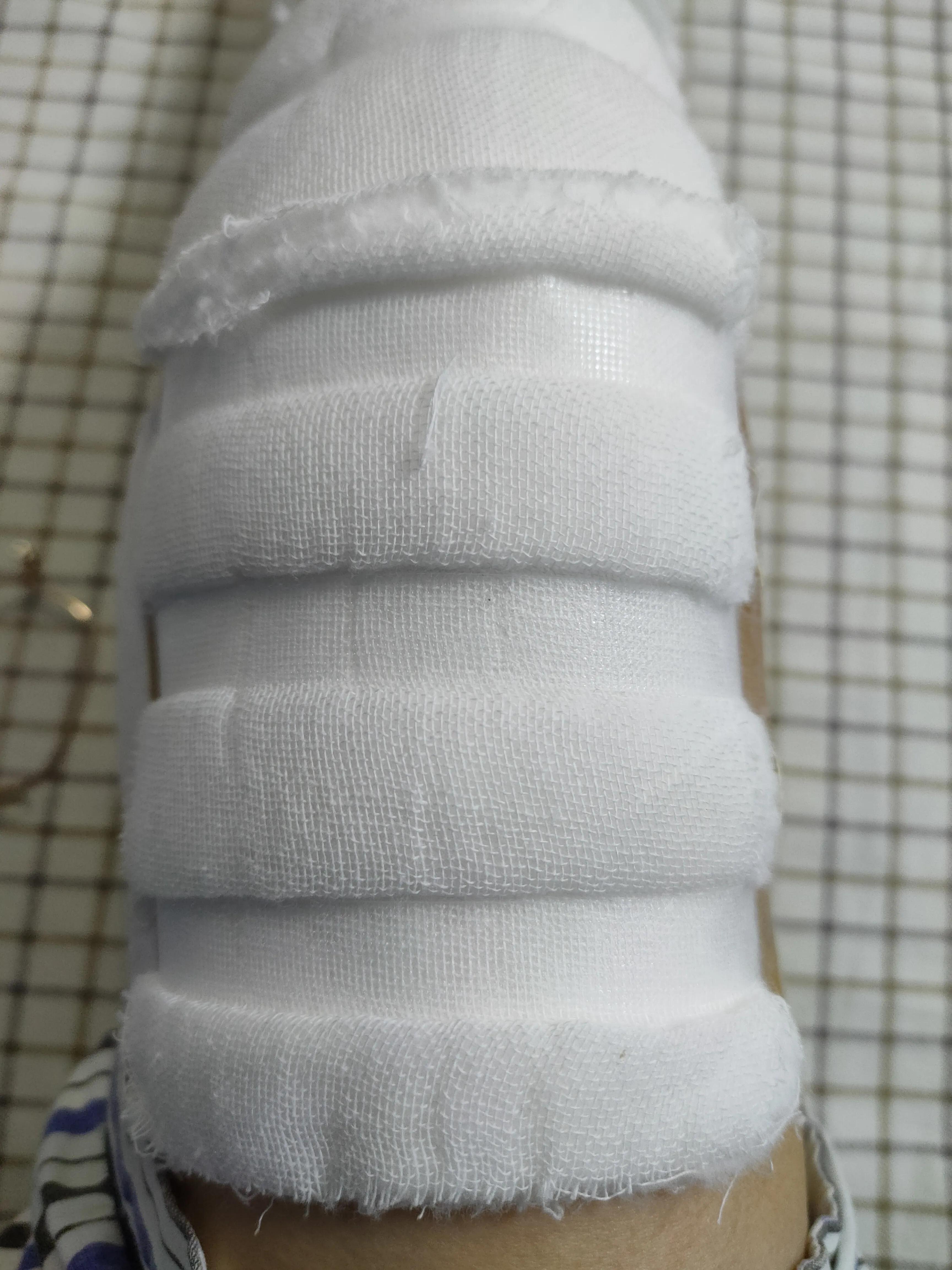 人工膝关节置换手术后，一个月时间里度日如年