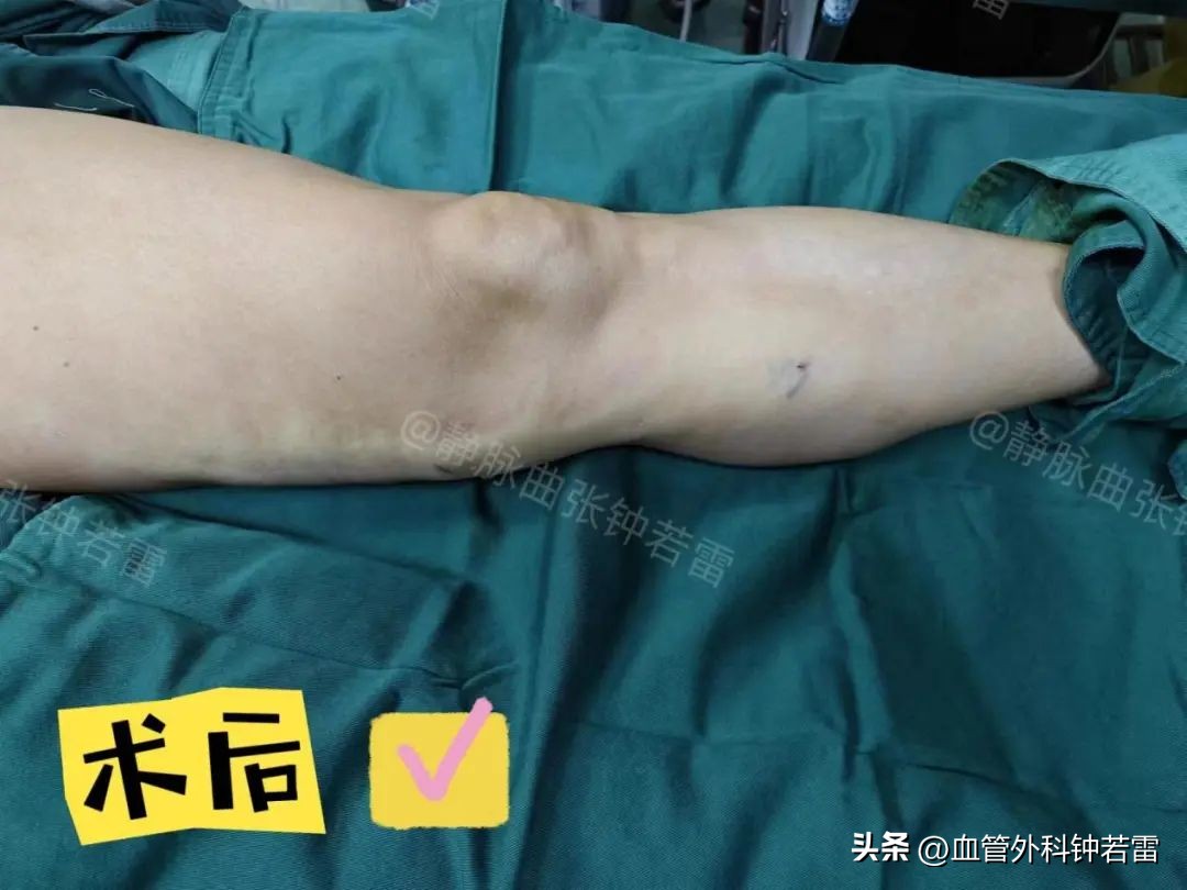 【静脉曲张案例34】61岁尹阿姨腿抽筋睡不着微创清零“小蚯蚓”
