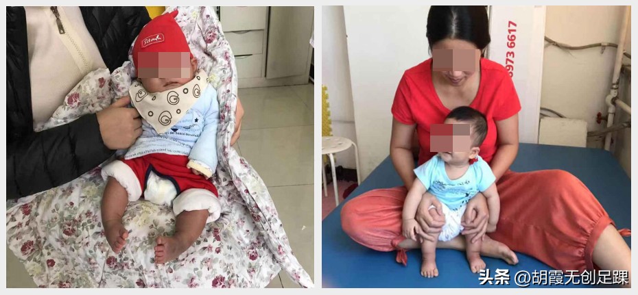 新生儿脚内翻在家怎么矫正,先天性髋内翻保守治疗