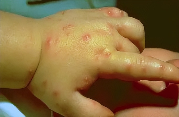 带娃出门游遇到蜱虫千万别乱拔,警惕这三种毒虫带娃出行必看