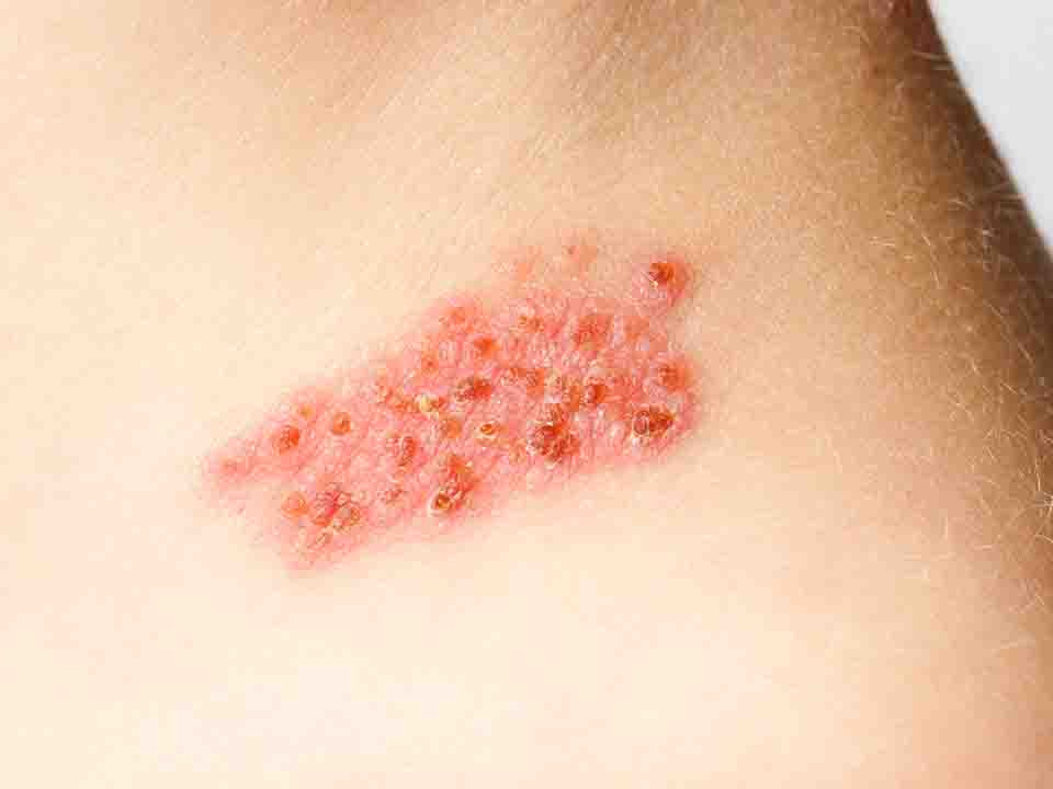 有一种疼痛就是带状疱疹的痛,疼痛难忍的疱疹