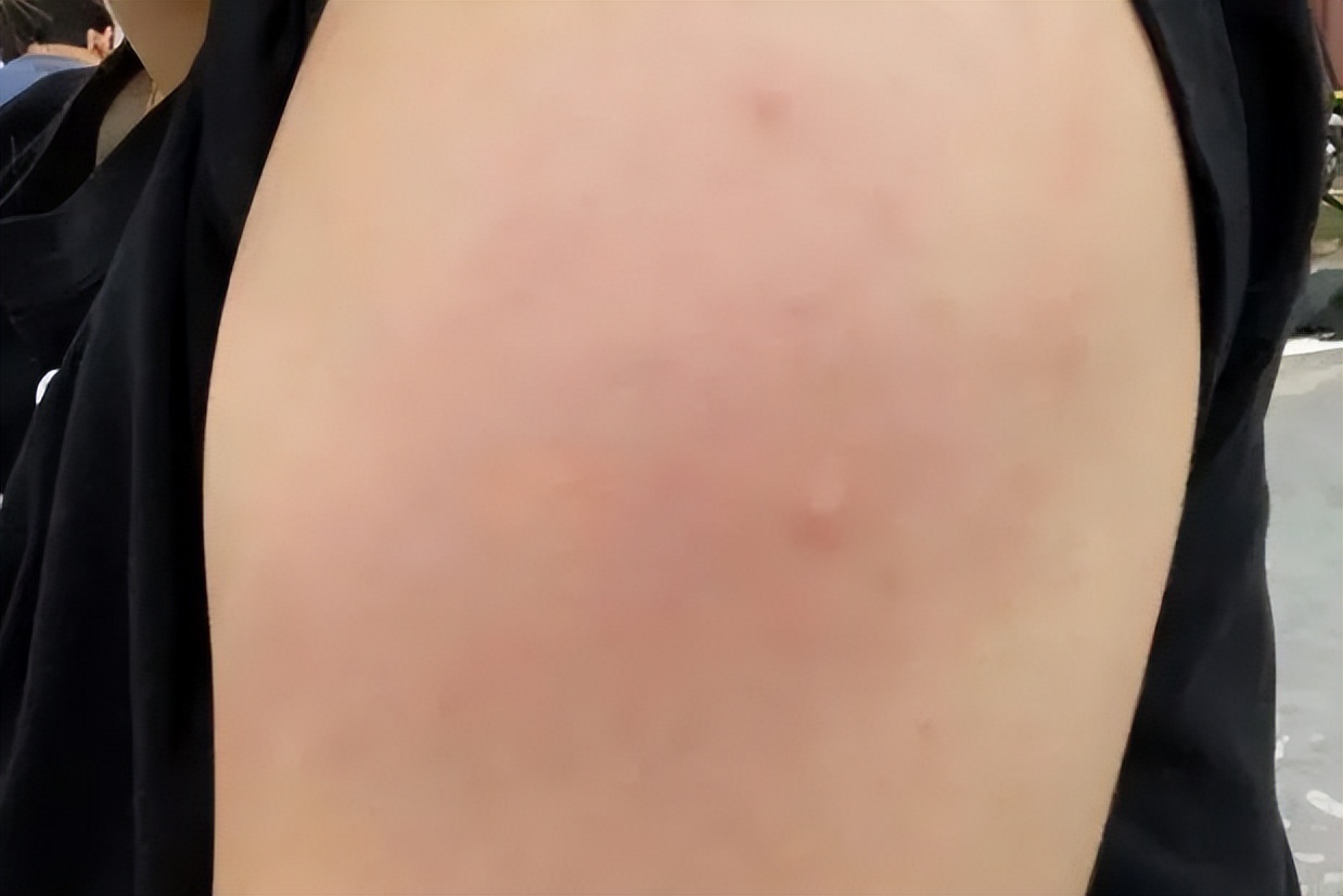 打完新冠疫苗之后手臂疼怎么回事,打过三针新冠疫苗后手臂又红又肿