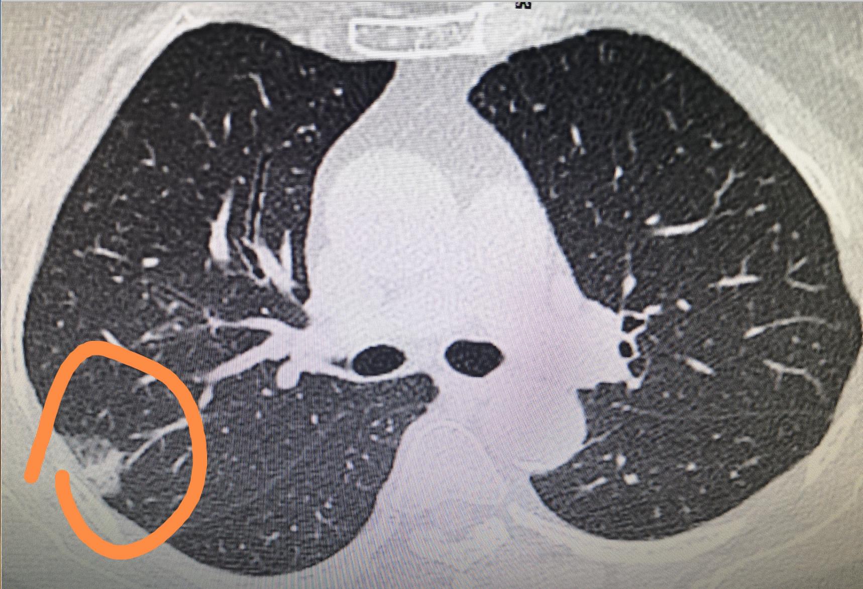 早期磨玻璃肺癌手术后有复发的吗,1a期磨玻璃浸润腺癌会复发转移吗