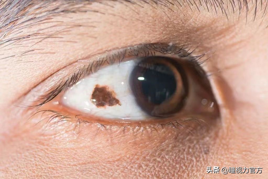 一岁半宝宝白眼球有黑斑,幼儿眼睛白眼球有黑斑