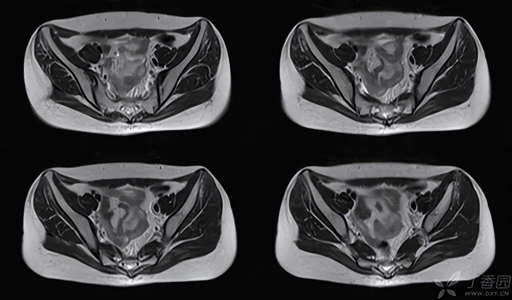 骨盆后环损伤后，新型螺钉的不同内固方法各有何优势？哪种方法好