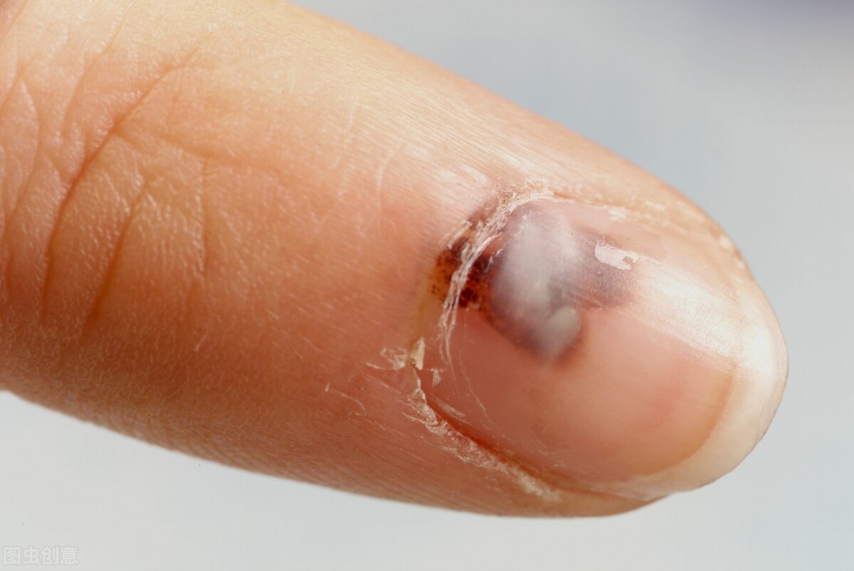 小伤口感染,伤口轻微感染吃什么药