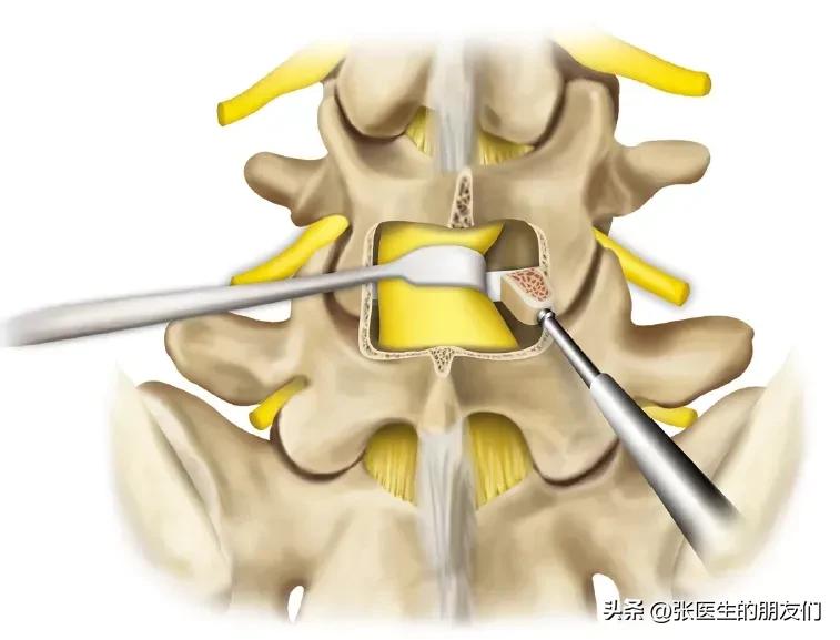 腰椎间盘突出十天治好,腰椎间盘突出保守治疗10年