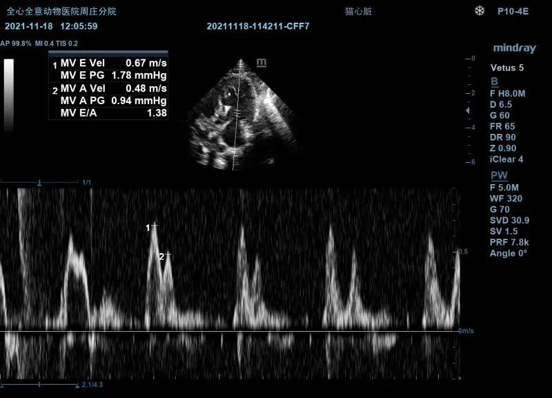 二尖瓣发育不良病例总结