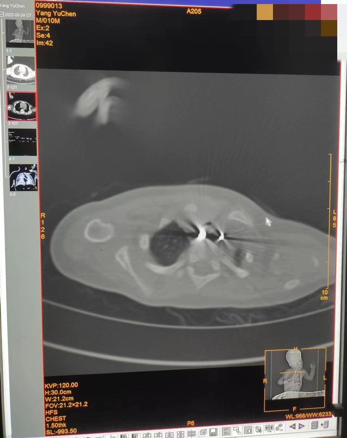 一例无痛小儿食道异物取出术