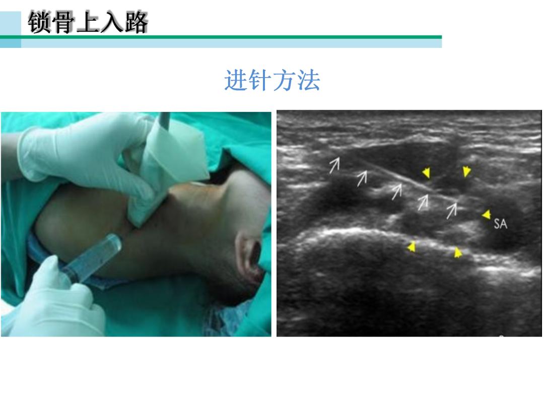 超声引导下臂丛神经阻滞,PPT课件