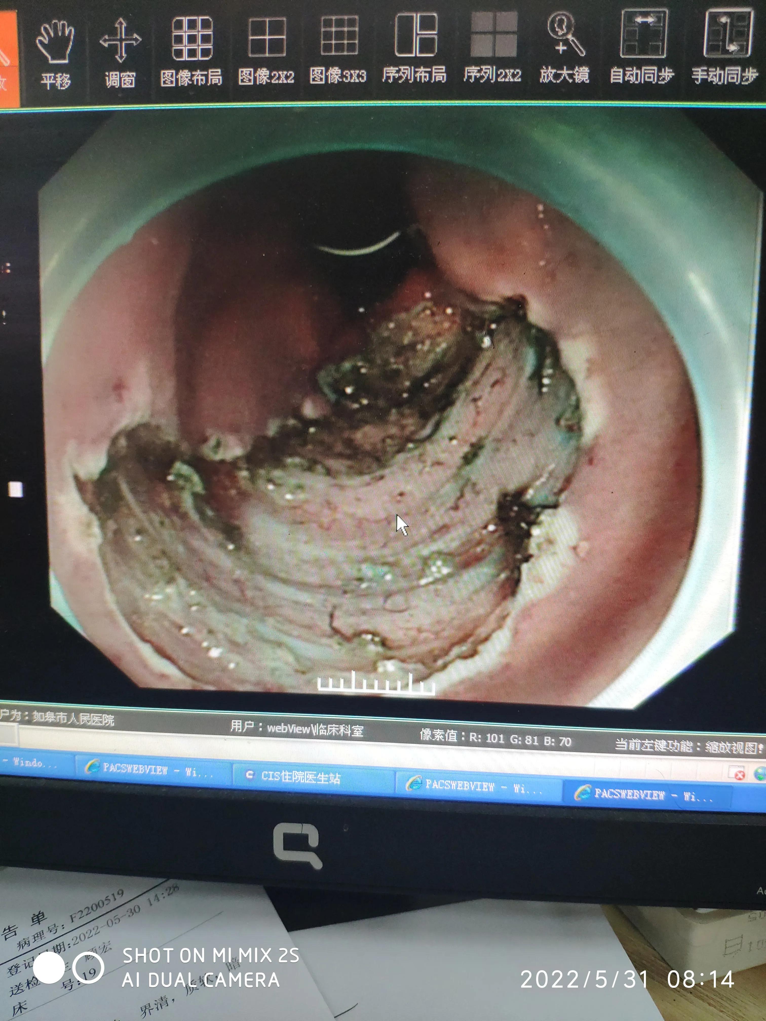 esd手术后续身体感觉,esd手术可靠吗