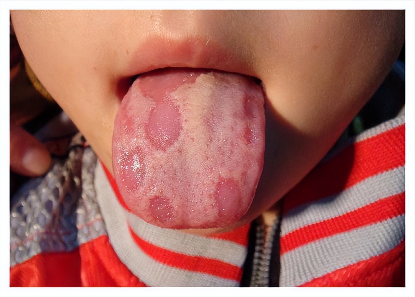 小孩积食的表现及解决办法,小儿厌食与积滞的区别
