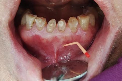 口腔牙龈内壁长硬包是上火吗,牙龈肿痛上火有个脓包怎么办