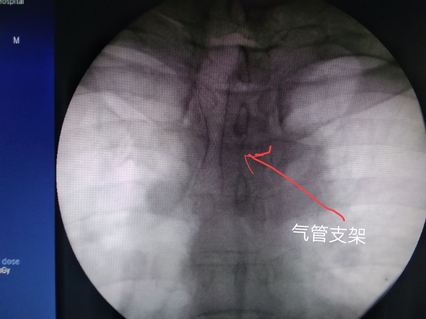肿瘤压迫气管呼吸困难护理措施,肿瘤压迫气管呼吸困难怎么办