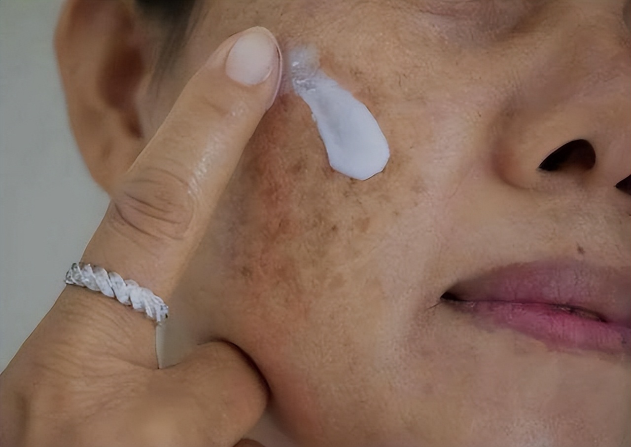 牙膏与红霉素软膏能祛老年斑吗,老年斑消除偏方红霉素软膏加甘油