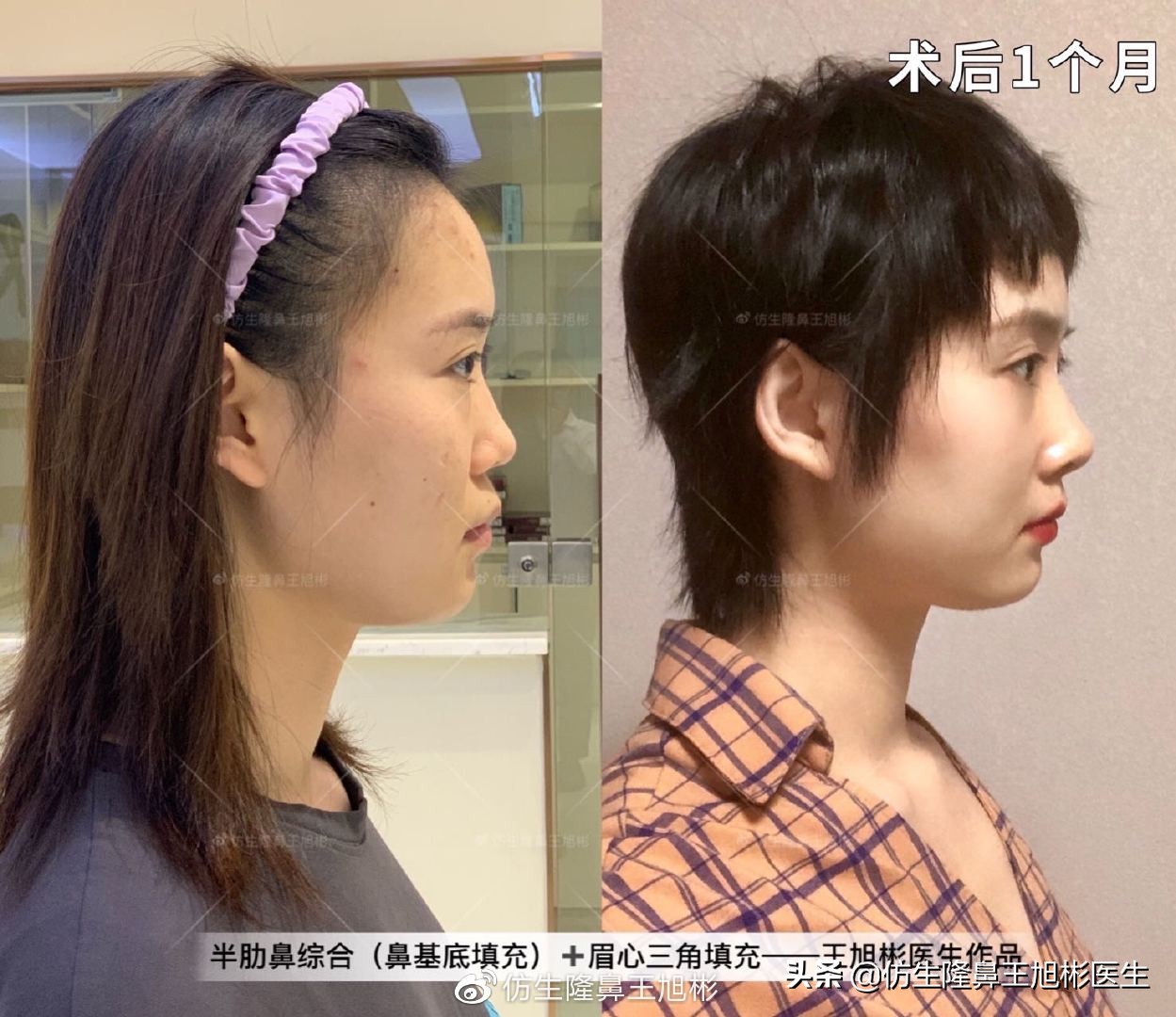 常见鼻部整形美容项目,整形鼻和自然鼻