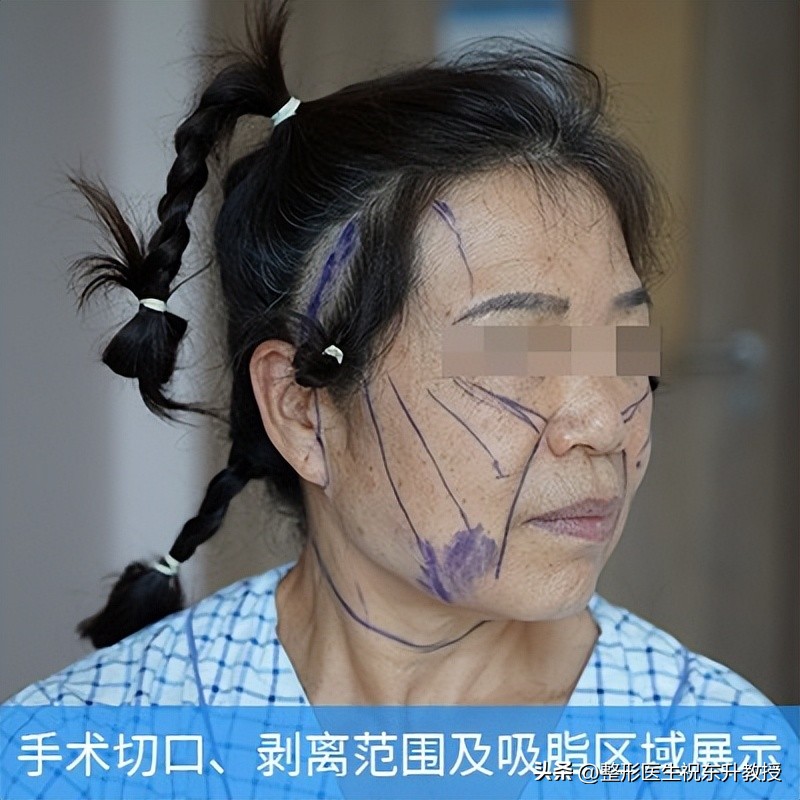 全脸拉皮手术前后的真实对比,脸部拉皮手术恢复过程图