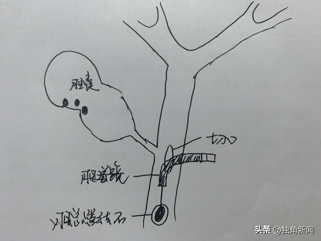 胆道微创,胆结石微创手术三个孔