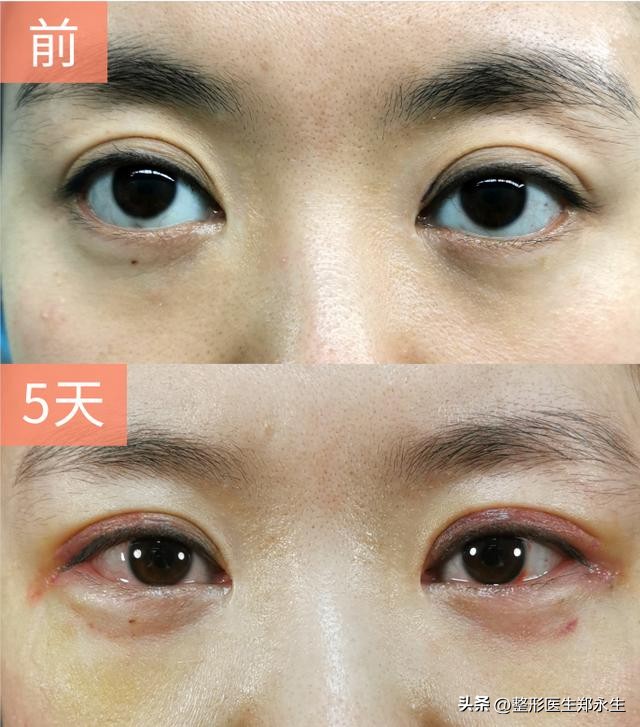 下眼睑磨得慌发涩怎么回事啊,下眼睑干的起皱起皮怎么回事