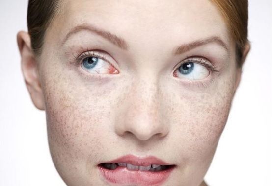 夏季阳光暴晒易导致脸上长斑怎么办？