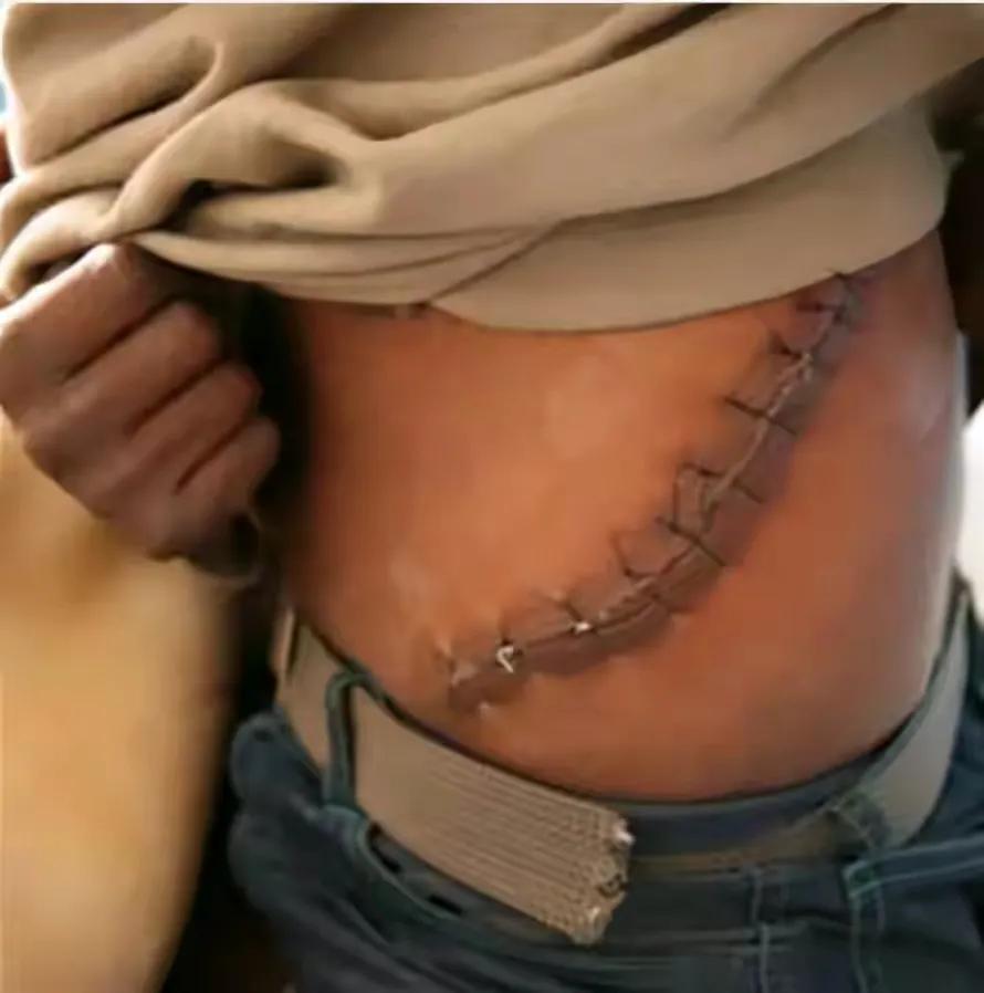 人少了一个肾，对身体危害大吗？9年前卖肾买手机的少年后悔了没