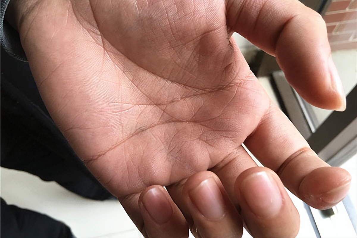 手脱皮的原因和治疗手脱皮方法,手皮肤脱皮的原因和治疗方法