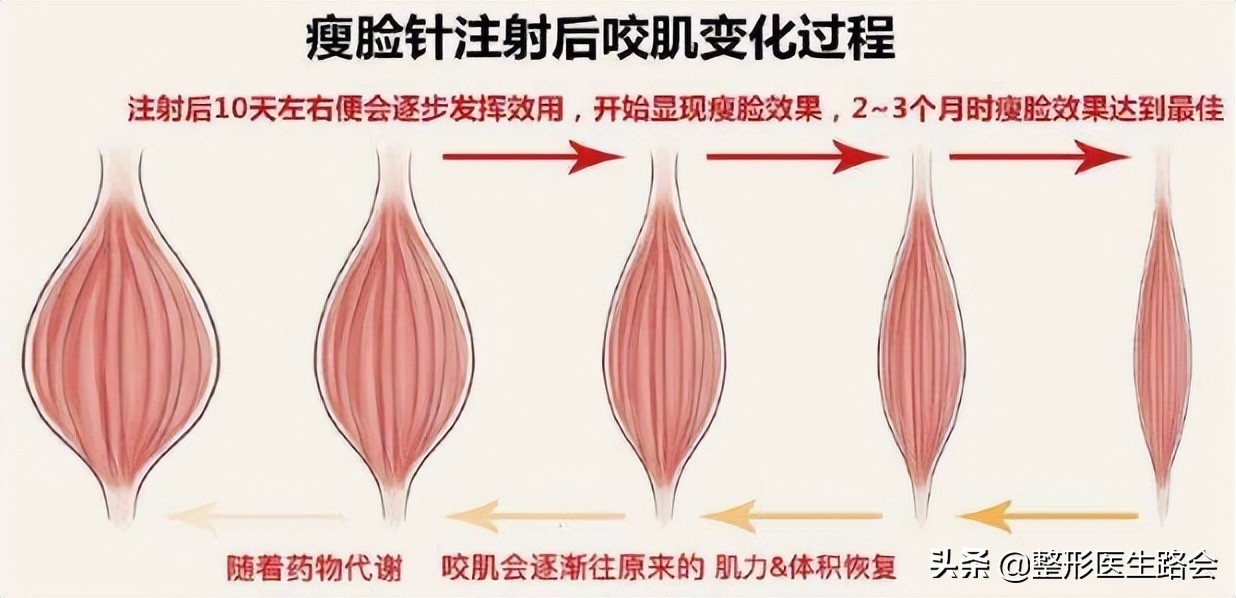除皱针十问十答,去皱针10问