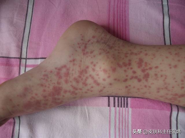 过敏性紫癜是怎样的病,过敏性紫癜怎样治疗才能断根