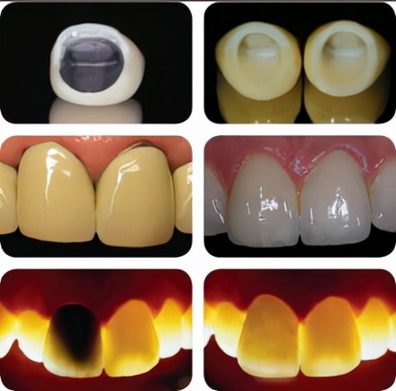 烤瓷牙好不舒服,烤瓷牙好不好看