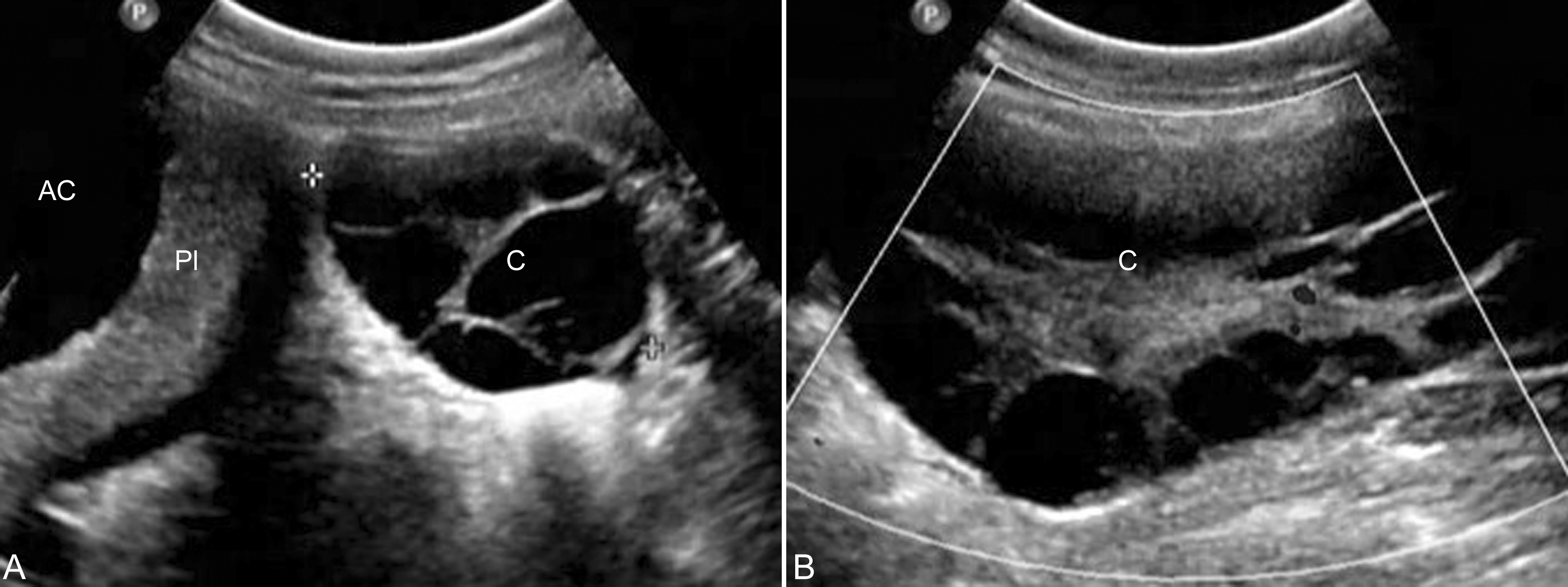 怀孕检查卵巢肿瘤良性恶性几率,妊娠合并卵巢肿瘤的鉴别诊断