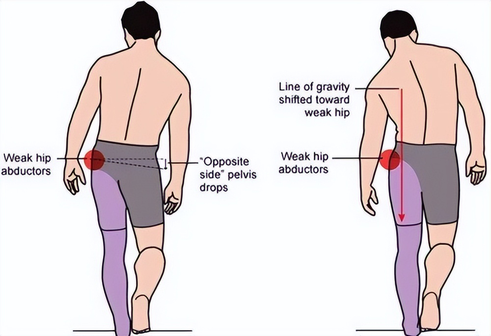 走路像鸭子臀中肌问题,走路左右摇摆像鸭子一样