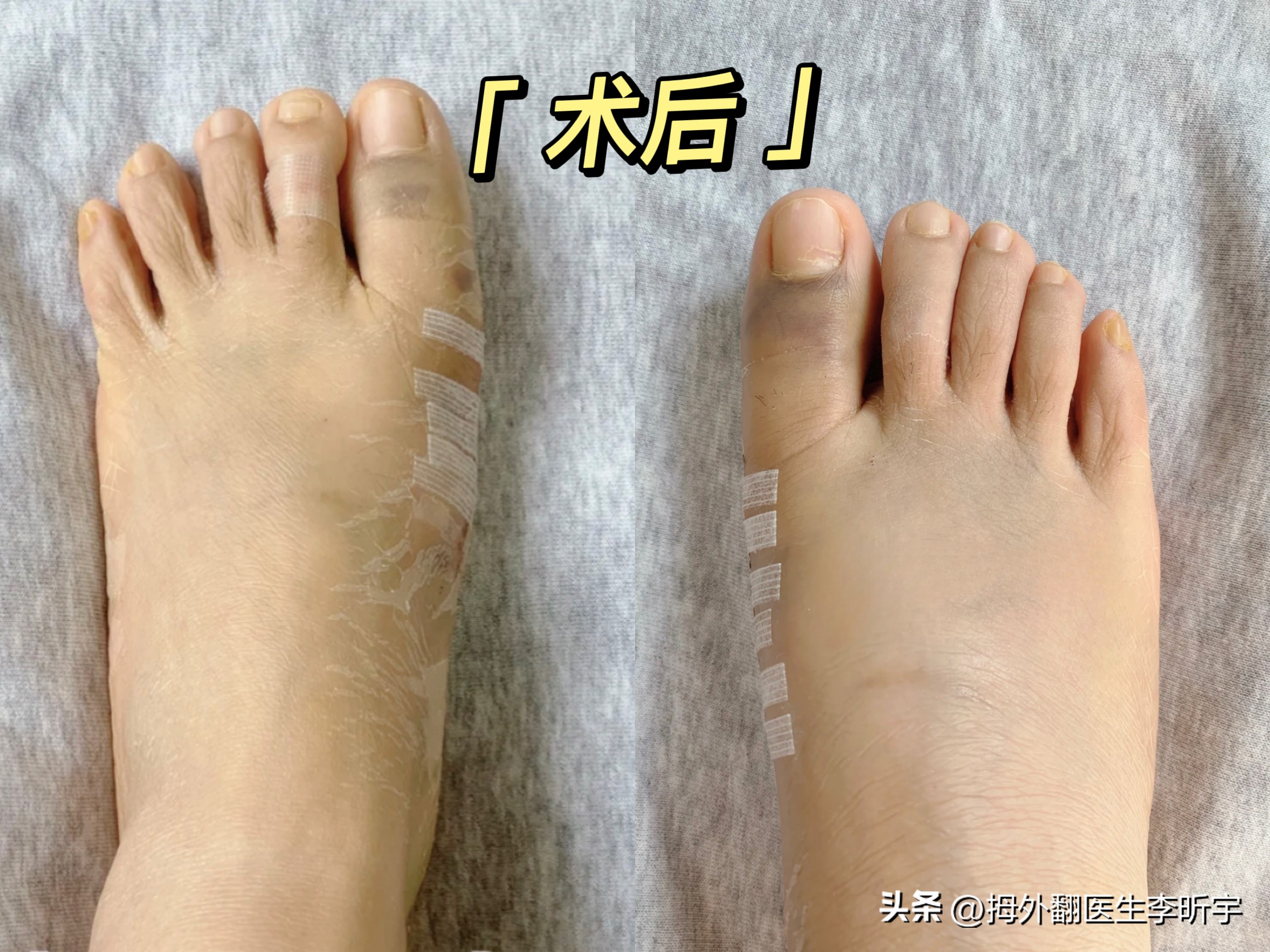 「案例分享」摆脱了多年的大脚骨，我现在是越看越喜欢！