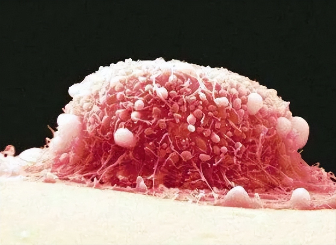 宫颈管内癌前病变,女性内裤有这迹象该留意宫颈癌