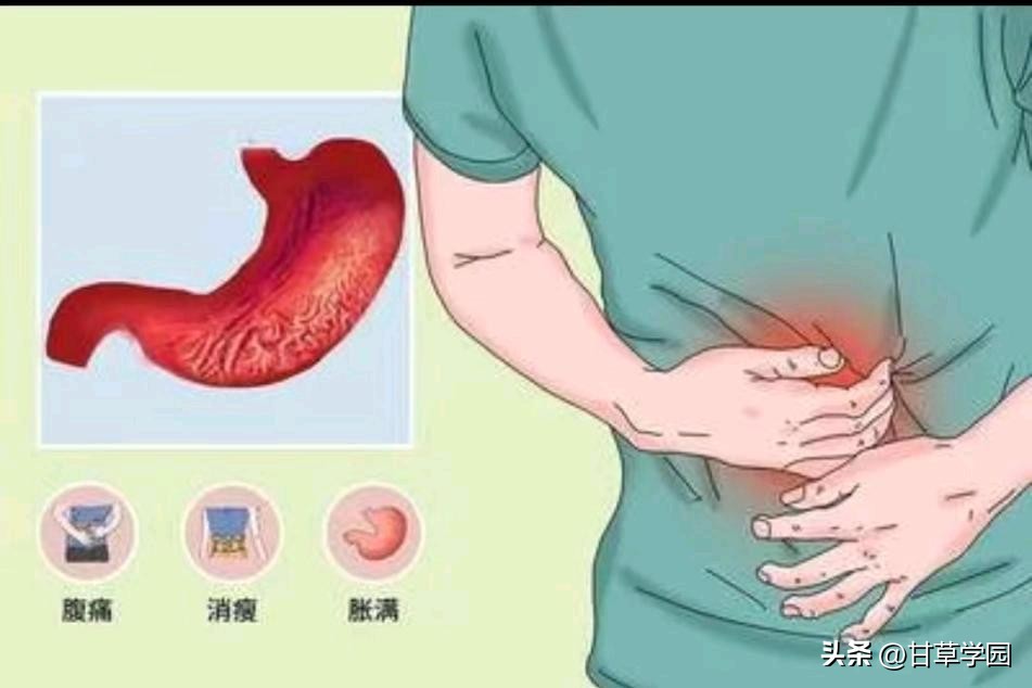 甘草学园|慢性萎缩性胃炎中医治疗