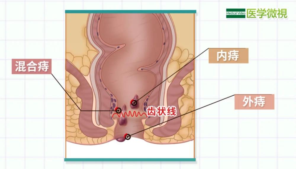 痔疮的中医诊疗方案,痔疮治疗临床经验报道