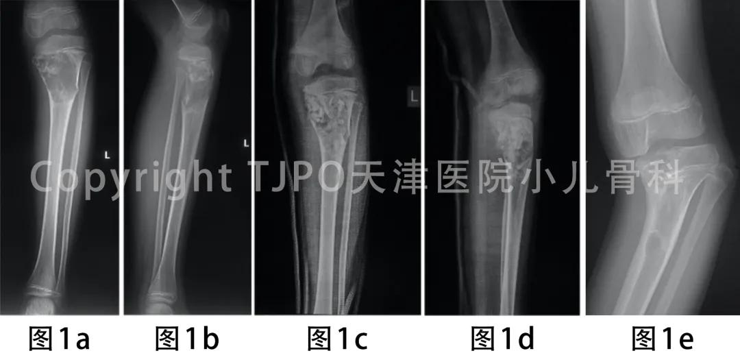 病例分享｜泰勒外固定支架逐渐矫正胫骨近端内翻伴短缩畸形