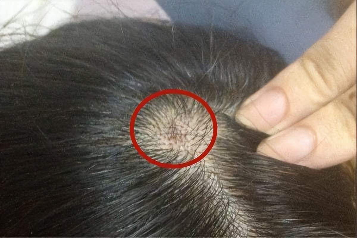 头皮上反复起脓包是怎么回事,头皮上长红疙瘩脓包头皮屑特别多