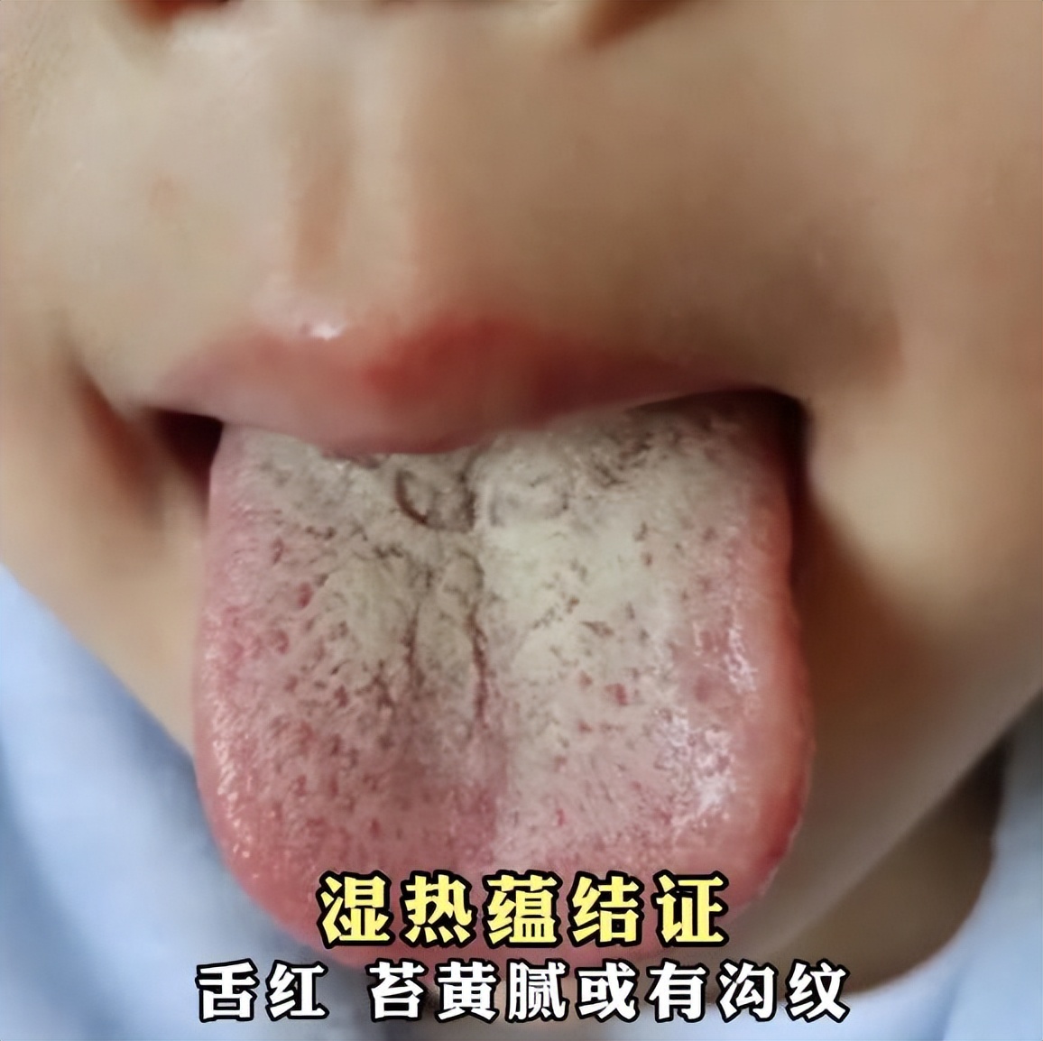 银屑病中医彩色图谱,银屑病舌象分型