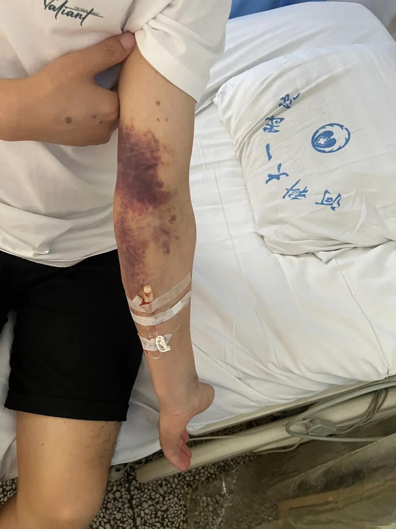 急性白血病的确诊依据,白血病m3的确诊方法