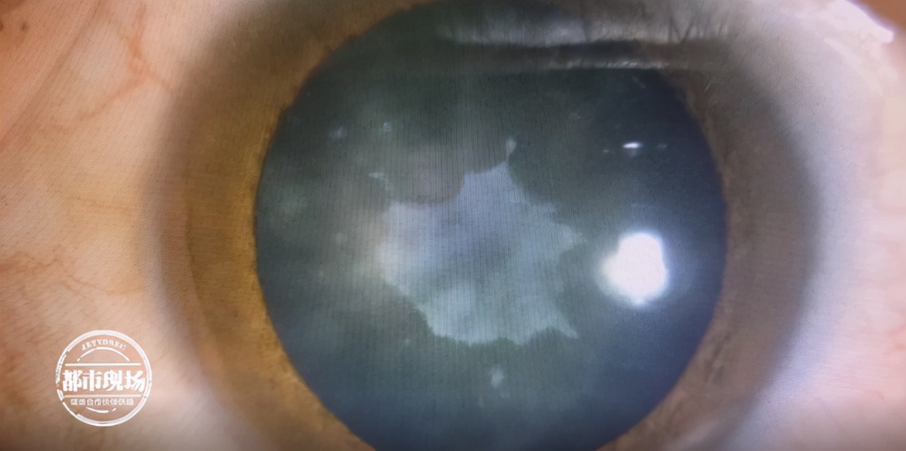 男子筋膜枪按摩眼睛患上白内障,用筋膜枪按摩眼睛险失明